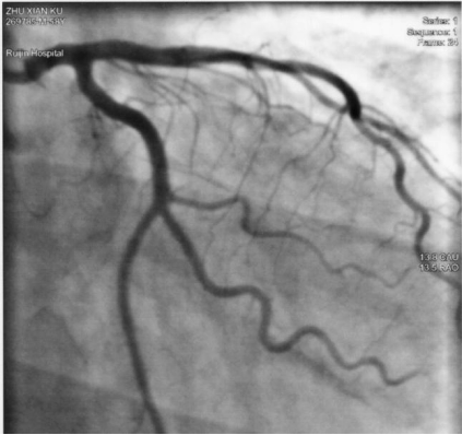 心臟介入源起導尿管插入心臟？