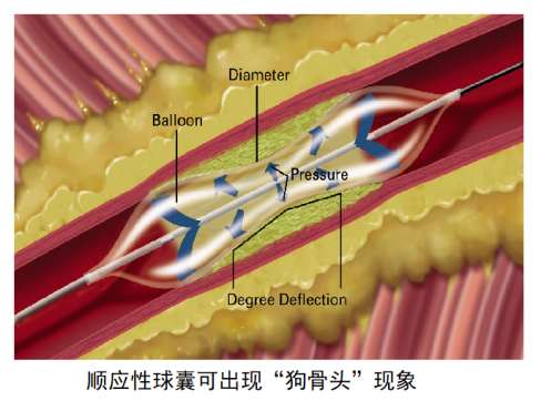 如何選擇PTCA球囊？命名壓和爆破壓指的是什么？