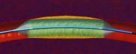 冠脈狹窄球囊擴(kuò)張后，需要放支架嗎？