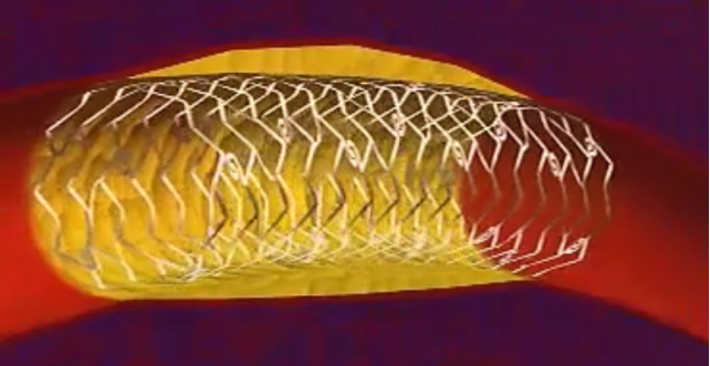 冠脈狹窄球囊擴(kuò)張后，需要放支架嗎？