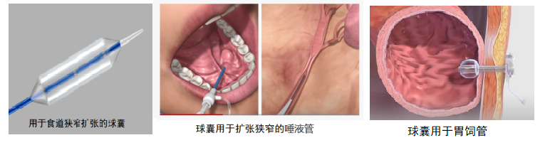 球囊技術(shù)在醫(yī)學(xué)上的應(yīng)用