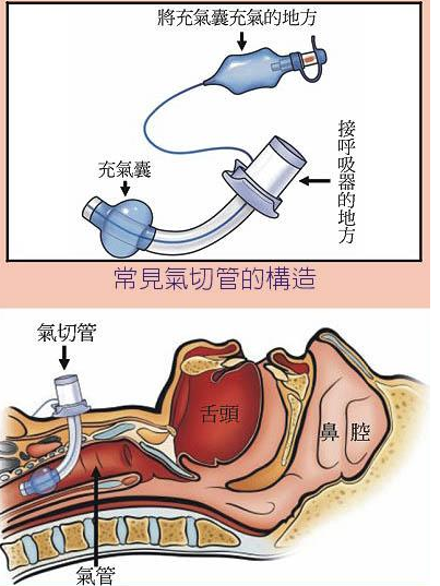 氣管切開套管護理要點