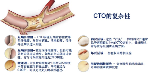 慢性閉塞病變的導(dǎo)絲選擇