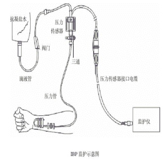 一次性血壓傳感器使用時(shí)間問題