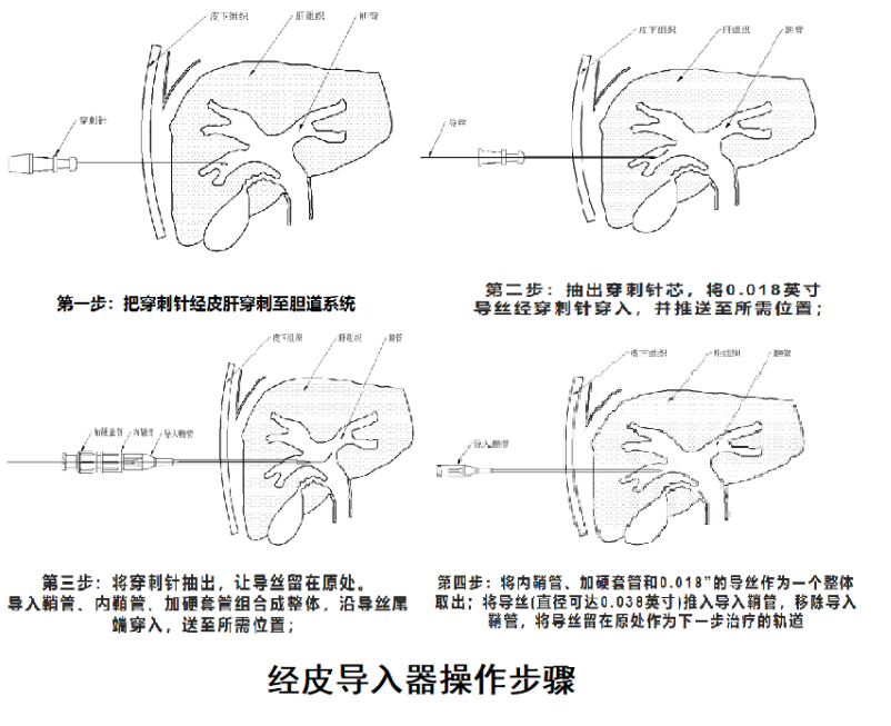 經(jīng)皮導(dǎo)入器：一種肝膽微創(chuàng)手術(shù)利器