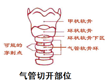 產(chǎn)品推薦：一次性使用氣管插管和氣管切開插管套件