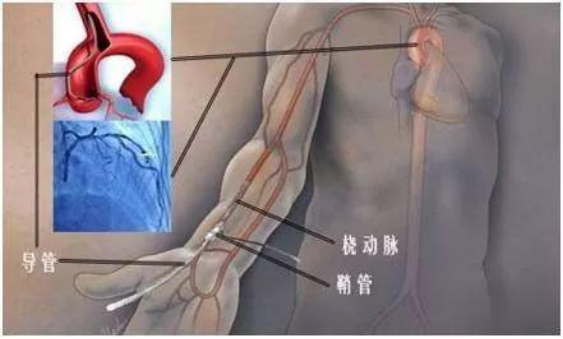 為什么越來越多的人選用橈動脈穿刺點做血管介入