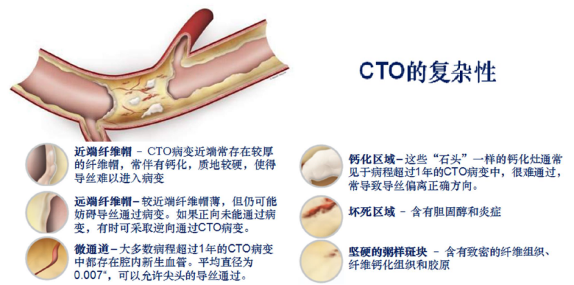 慢性完全閉塞病變的導(dǎo)絲選擇