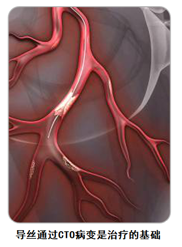 慢性完全閉塞病變的導(dǎo)絲選擇
