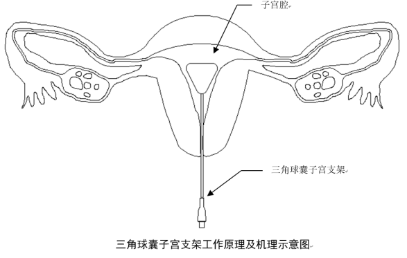 球囊技術(shù)在醫(yī)學(xué)上的應(yīng)用