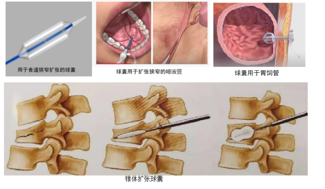 球囊技術(shù)在醫(yī)學(xué)上的應(yīng)用