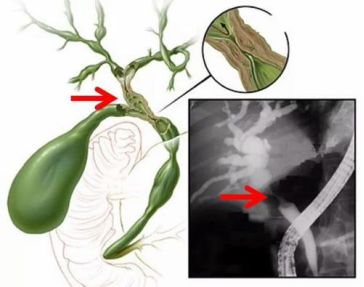 經皮肝穿刺+膽道引流術 有關問題的解答