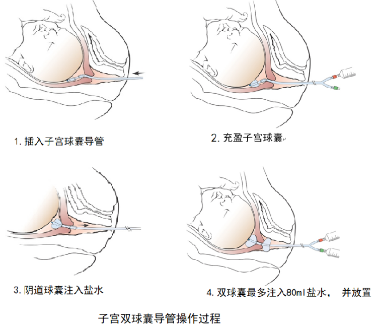 產(chǎn)品推薦：子宮頸擴張球囊導(dǎo)管