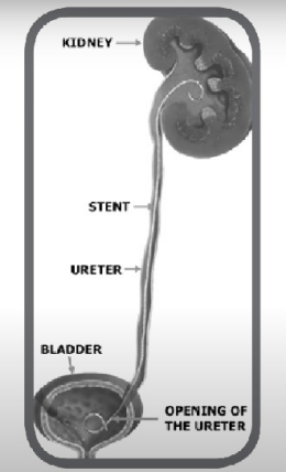 輸尿管支架的應(yīng)用