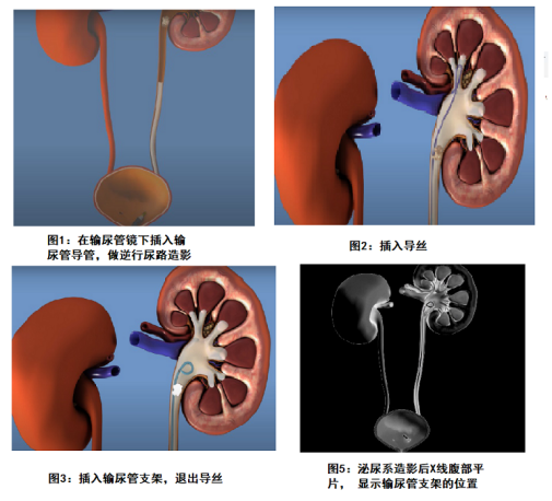 輸尿管支架的應(yīng)用