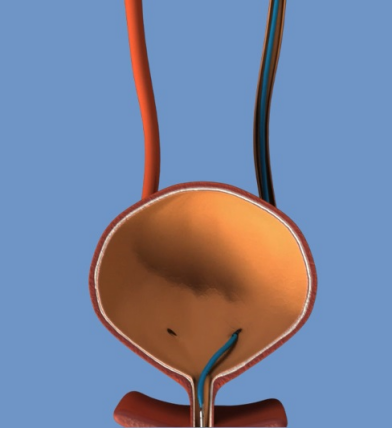 輸尿管支架的應(yīng)用