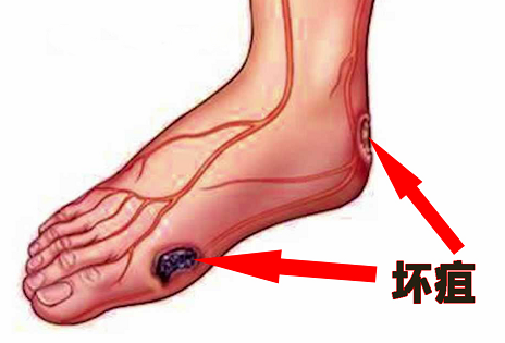 糖尿病的血管病變