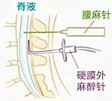 椎管內(nèi)麻醉比較