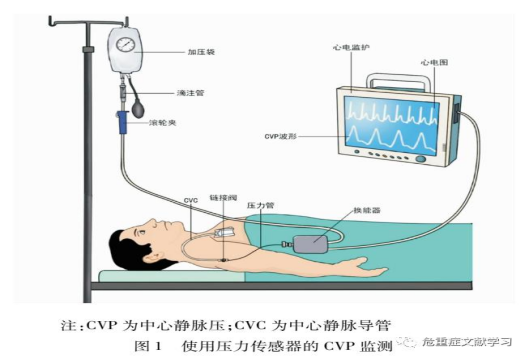 產(chǎn)品推薦： 中心靜脈導(dǎo)管
