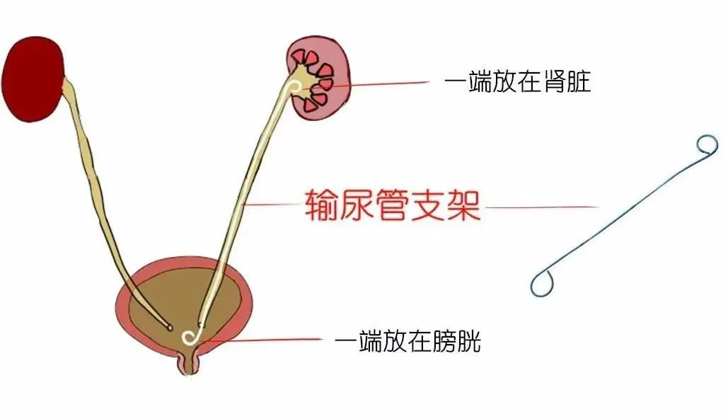 輸尿管支架的由來和使用注意事項(xiàng)