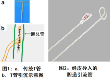 經(jīng)皮經(jīng)肝膽管引流術