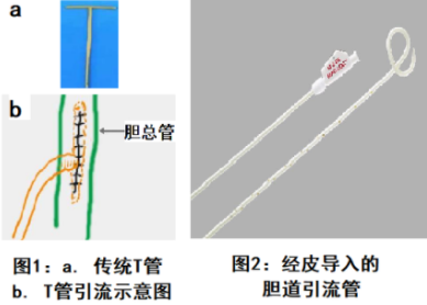 肝膽引流技術(shù)