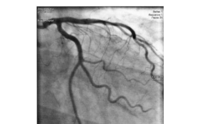 血管造影導(dǎo)管