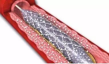 球囊擴(kuò)張后，需要放支架嗎？