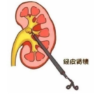 產(chǎn)品推薦：經(jīng)皮腎擴(kuò)張?zhí)准?yīng)用