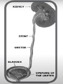 輸尿管支架的應(yīng)用