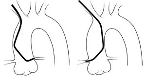 產(chǎn)品推薦：造影導(dǎo)管
