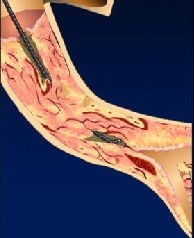 慢性完全閉塞病變的導(dǎo)絲選擇