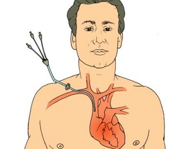 美國CDC/HICPAC血管內(nèi)導(dǎo)管相關(guān)感染預(yù)防指南（概要）