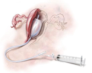 一次性球囊子宮支架的臨床應(yīng)用