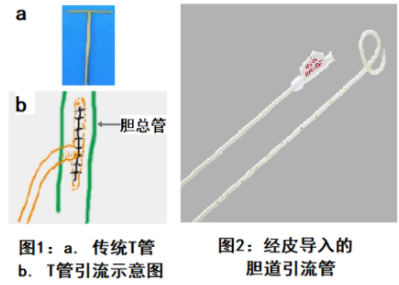 肝膽管引流術(shù)