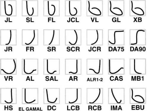 冠脈指引導管的應(yīng)用