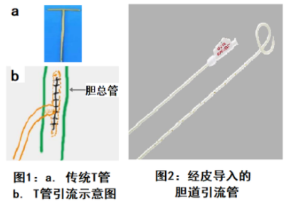肝穿膽道引流術(shù)